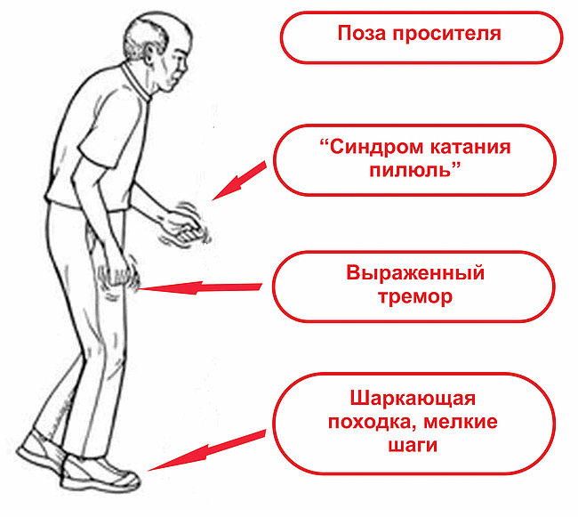 Тремор лечение в домашних условиях 219 Тремор лечение в домашних условиях 327